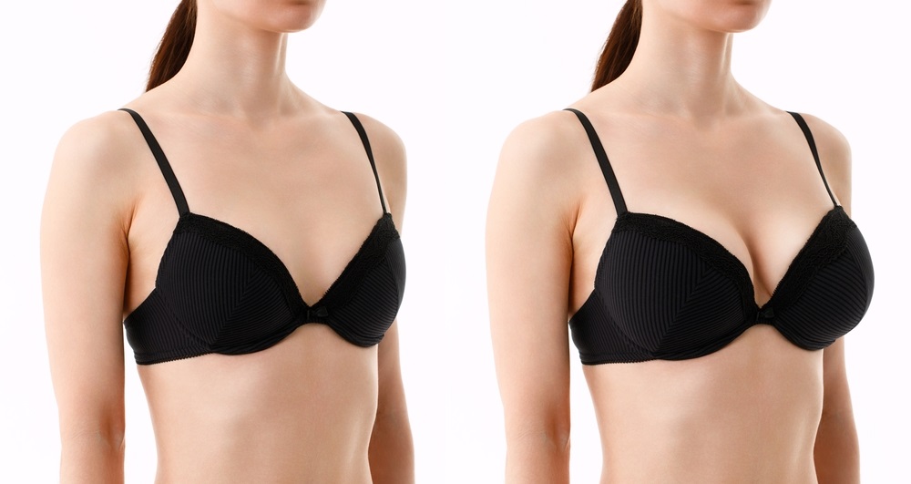 αυξητική στήθους πριν και μετά.