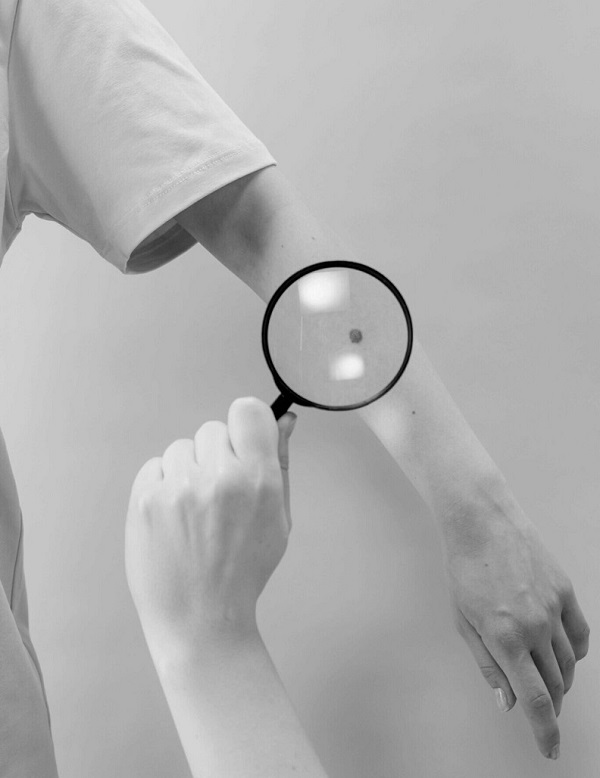 χειρουργικη αφαρεση σπιλων