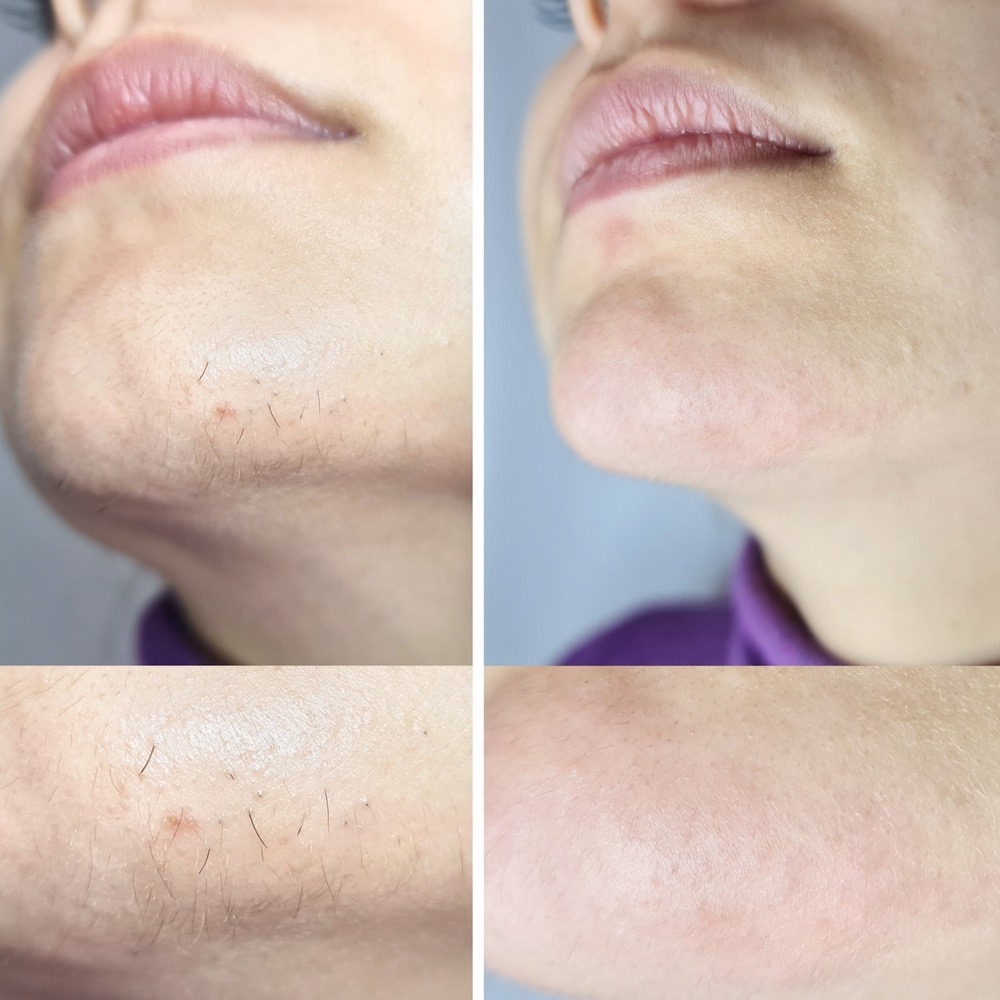 laser αποτριχωση πριν και μετά 